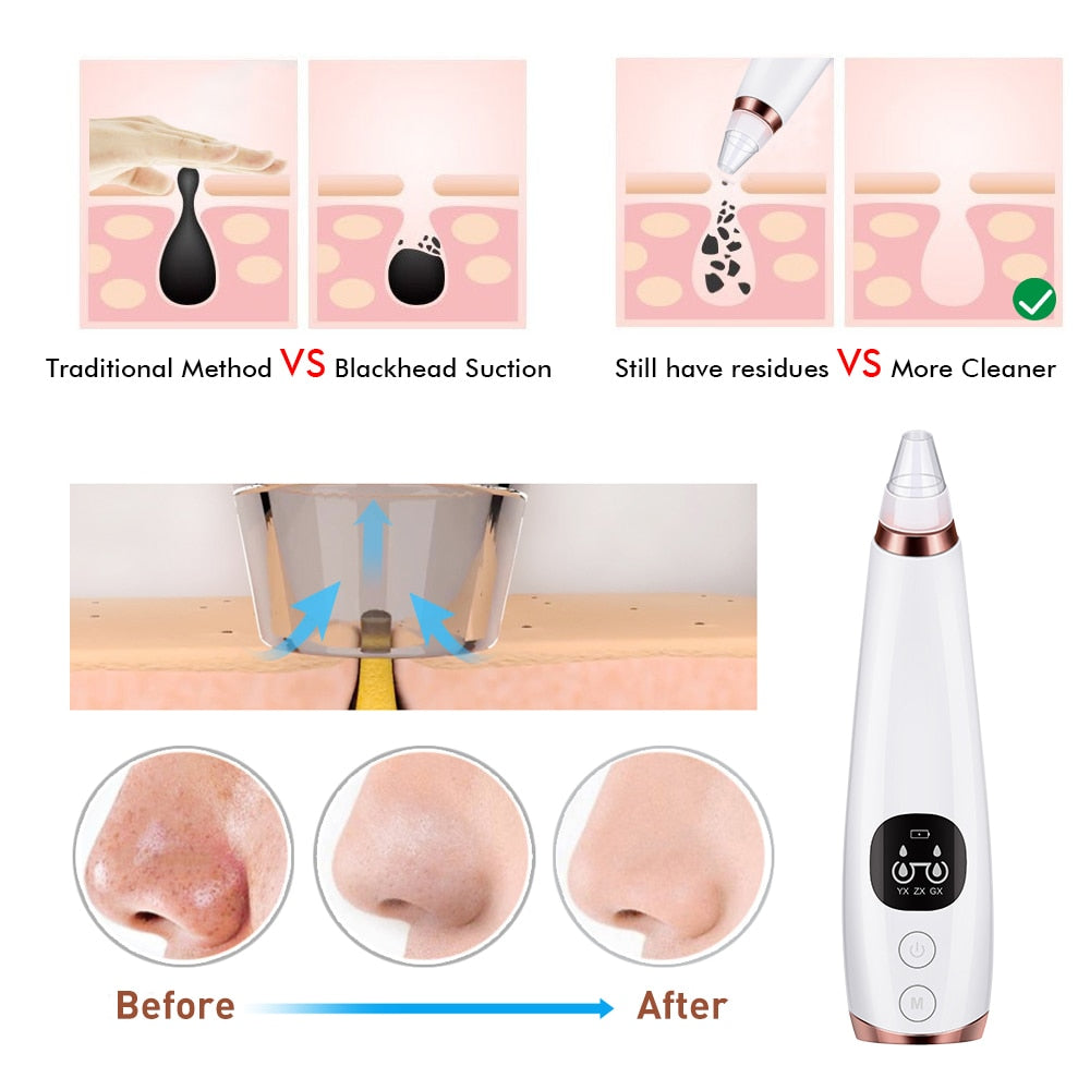 Microdermabrasion Facial Pore Cleaner